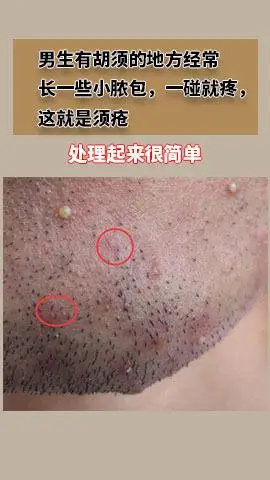 男生有胡须的地方经常长一些小脓包一碰就疼这就是须疮