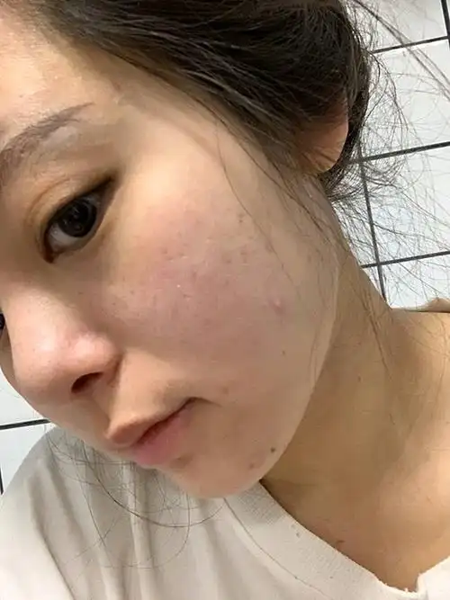 青春期的男孩女孩很多都会存在青春痘_圈子-新氧美容整形