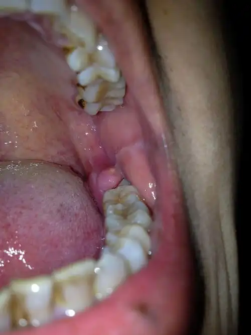 智齿那里的牙龈肿了,还有一个白点