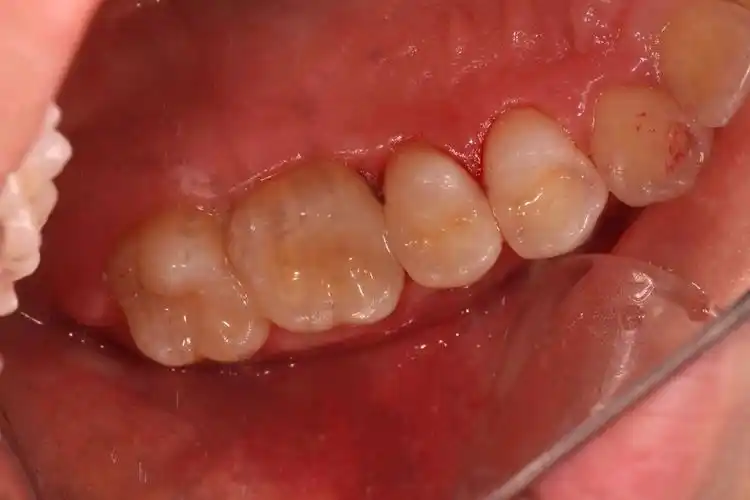 后牙邻面龋坏之即刻嵌体修复