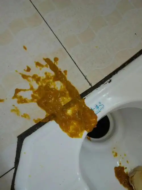 这两天下午的大便成蛋花状大便～是拉肚子还是消化不良呢?求助