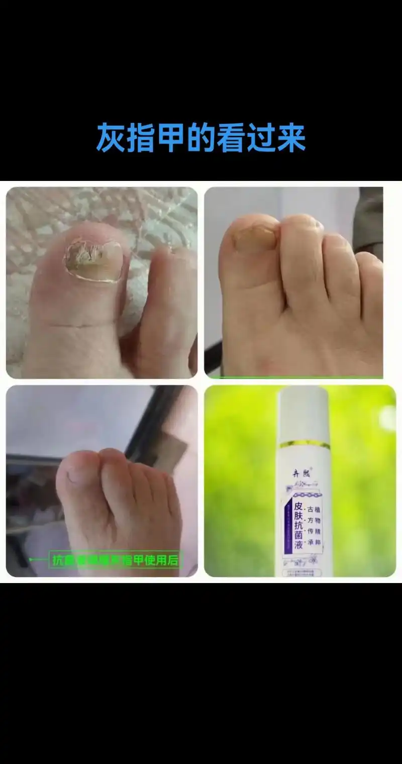 灰指甲的看过来.科普一下 灰指甲形成有三个途径 166:脚气交 - 抖音