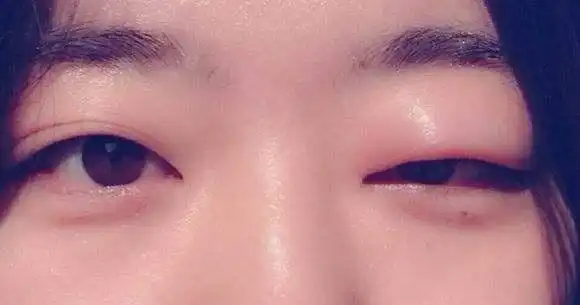 注意!每天早上起床眼睛肿,你可能是生病了哟!_眼睑