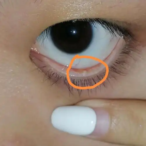 下眼皮里这个白色的是什么啊