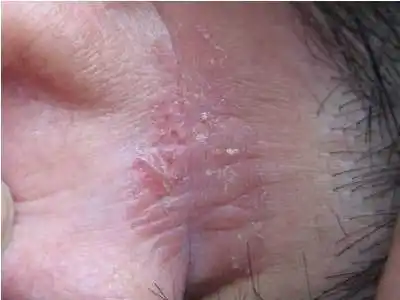 怎么选择治疗湿疹的医院