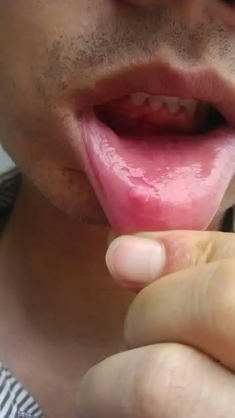 下嘴唇里面长了个肉疙瘩,大概有四五月了,平时没任何感觉,就是有时