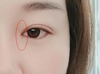 这里所说的开眼角常指的是开内眼角,开内眼角手术需要切开内眦角,只要