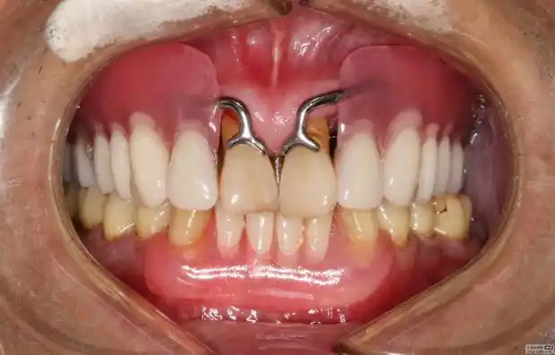 患者73岁,戴过活动义齿,现在想更换,但不愿拔除上颌中切牙.