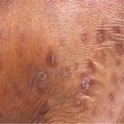 性病图片_性病症状表现图片大全_有来医生