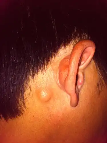 请问右边耳朵后面涨了一个疙瘩不痛不痒