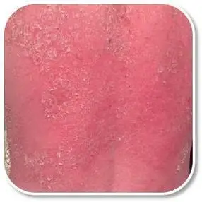 红皮病型牛皮癣应当如何选择适合的药饮治疗缓解呢?