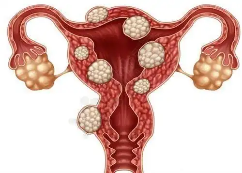 科普:子宫肌瘤对身体的影响究竟有多大呢? - 柚喜