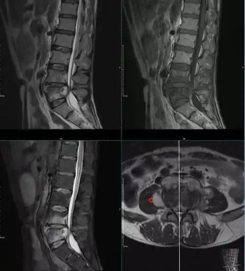 椎体终板炎发生机制分型以及mri表现