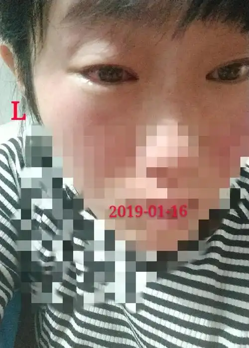 外伤致急性角膜炎一例