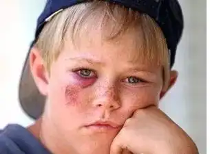 面部擦伤后怕留瘢痕,教你几招!