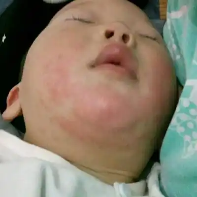 这是过敏了还是流口水流的