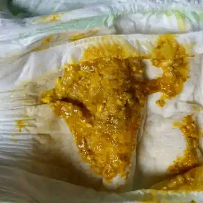 你好,我家宝宝出生15天了,每次拉屎都带有奶瓣,有点像蛋花,这是正常