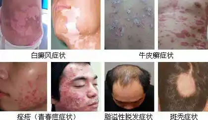 常见皮肤病的种类及症状图片