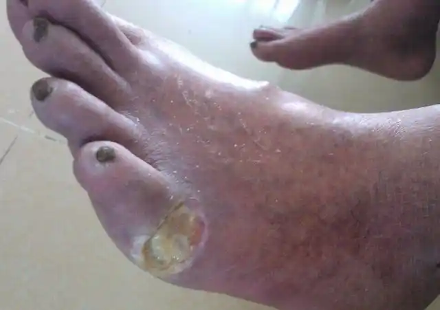 5,脚部皮肤溃烂如果没有及时控制住血糖,会使血管受到刺激,神经系统