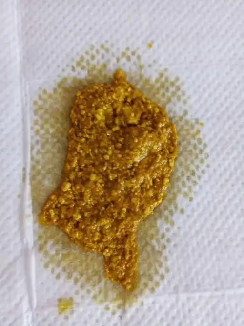 宝宝大便有颗粒和黄水