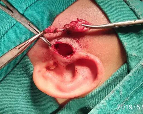 秦昊秦昊医生手记20190515耳前瘘管切除