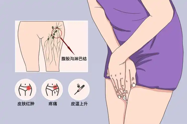 女性大腿根部淋巴结肿大图片