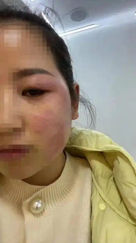网友爆料美容成毁容在如皋花田雨美容店注射瘦脸针后脸部红肿溃烂
