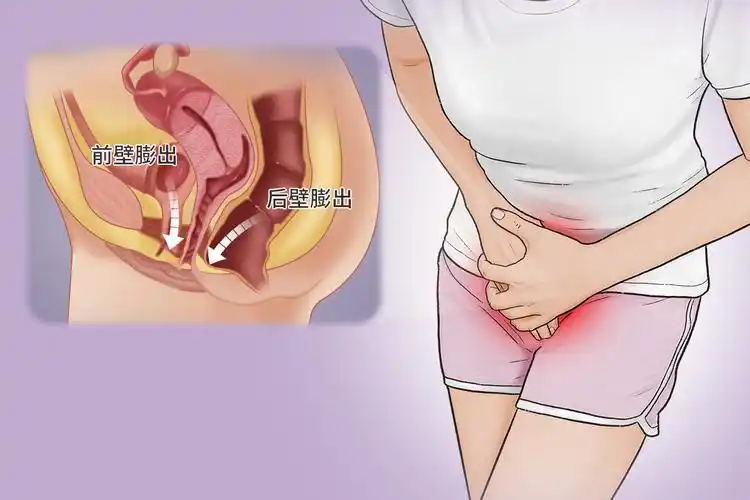 阴道前后壁膨出