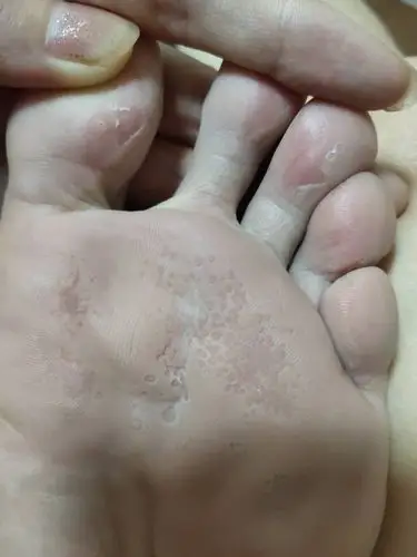 皮肤科,我穿了鞋子为什么我的一直脚,脚板和脚趾掉皮,并且我还不知道