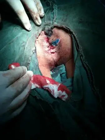 今天做的坎顿混合痔