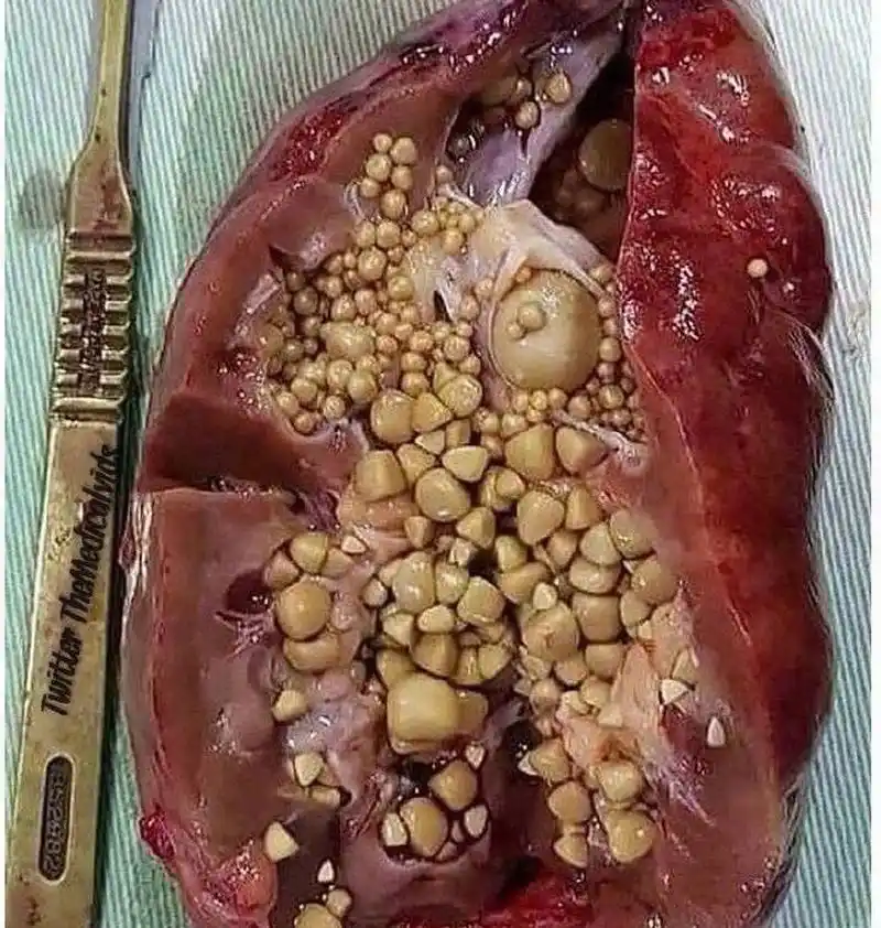 要怎么预防肾结石呢?