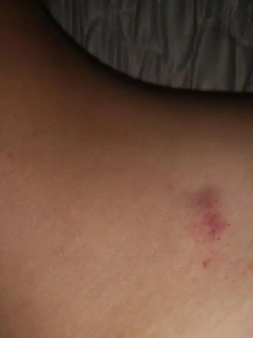 吻痕鉴定,请大家帮我鉴定一下这个是否是吻痕