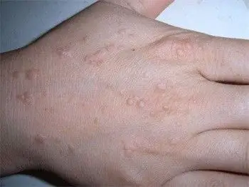 在江门治手背上的扁平疣要多长时间才能好?