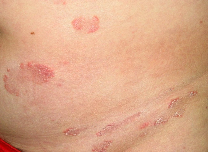 梅毒前期小红点图片 (13)