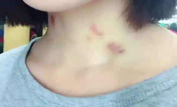 情侣接吻时在脖子上"种草莓",可能带来这两个影响,不妨看看!