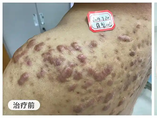 患者信息后背大面积疤痕疙瘩