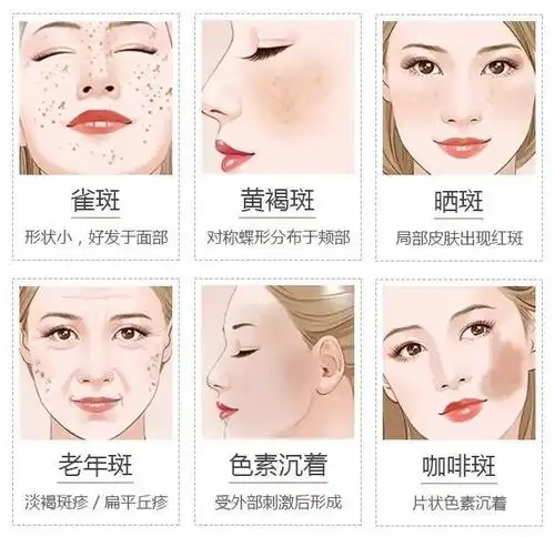 晒斑,雀斑和黄褐斑问题上,我们需要