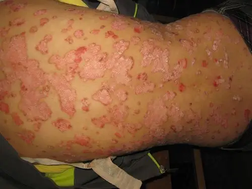 看图识病---------银屑病