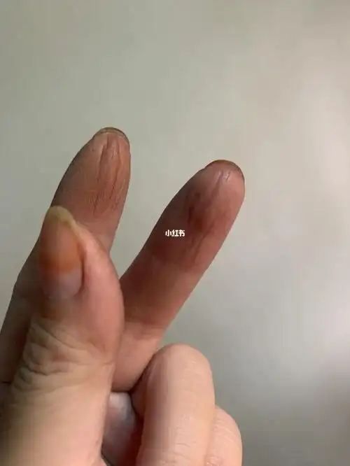 一个月了手指一直是黑的