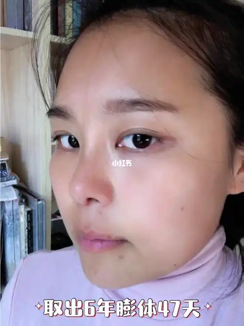 取出鼻假体47天_鼻假体取出_美妆_医美整形