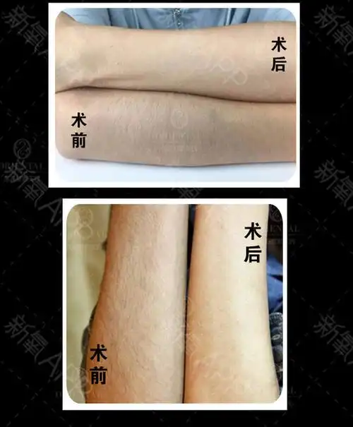 【激光脱毛】比基尼线脱毛 1次 ,【比基尼脱毛】冰点无痛脱毛,阳光