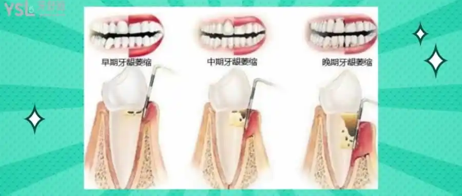 二,牙龈萎缩是什么原因造成的?