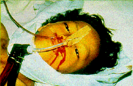 【胆小勿进】埃博拉病毒病人图片如僵尸 埃博拉病毒复活可产生"活死人