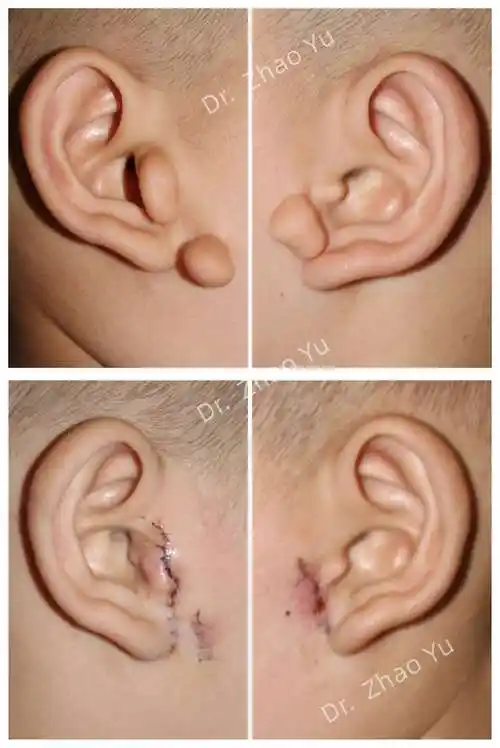 耳前长"拴马桩"是福气的象征吗?该怎么办?