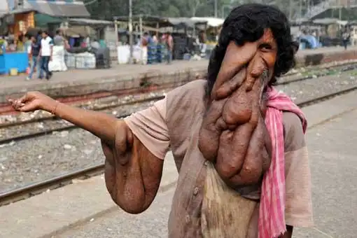 印度"象人"有神一般的长相,却是叫花子的命,幸好遇到了她!