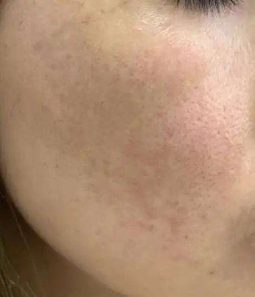 波波医生说护肤—— |多管齐下淡化色素斑