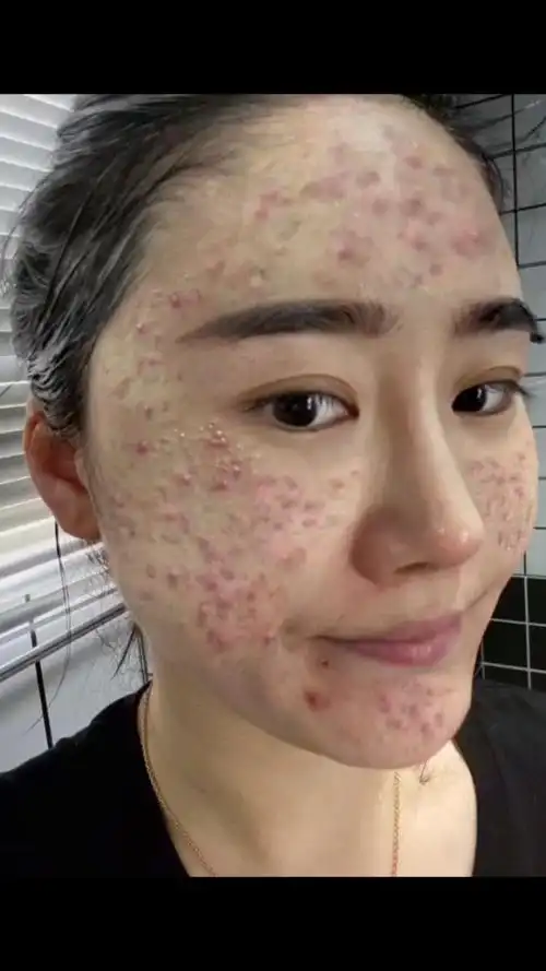 做梦都不敢相信七年的烂脸竟然被一瓶水搞定.#痘痘逆袭 #逆袭之路