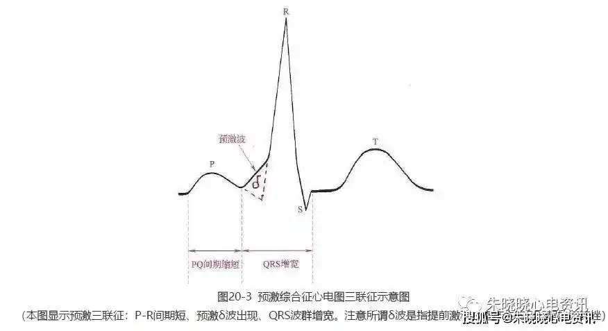 第二十讲预激综合征一