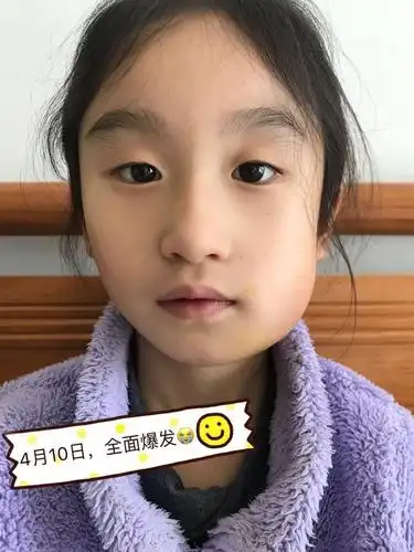 被三家医院拒诊—妈妈如何面对孩子的腮腺炎?