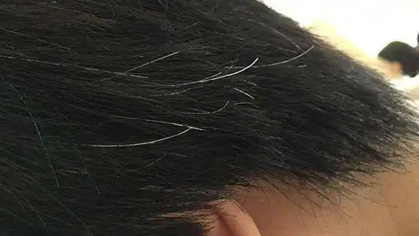 白头发增多有可能是缺乏营养不一定年纪大才头发白